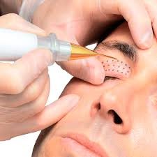 "Corrección de párpados caídos y bolsas mediante tecnología Plasma Pen."

"Lifting no quirúrgico de párpados con Plasma Pen para mirada más 