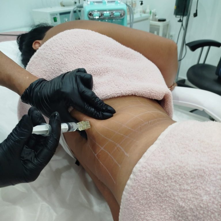 "Reducción de volumen abdominal mediante mesoterapia estética sin cirugía."

"Tratamiento reductor en abdomen con mesoterapia, 